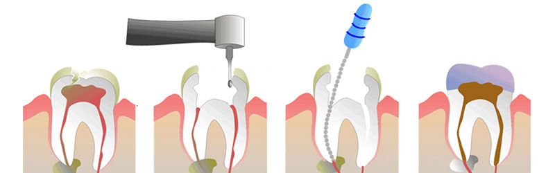 Endodonzia