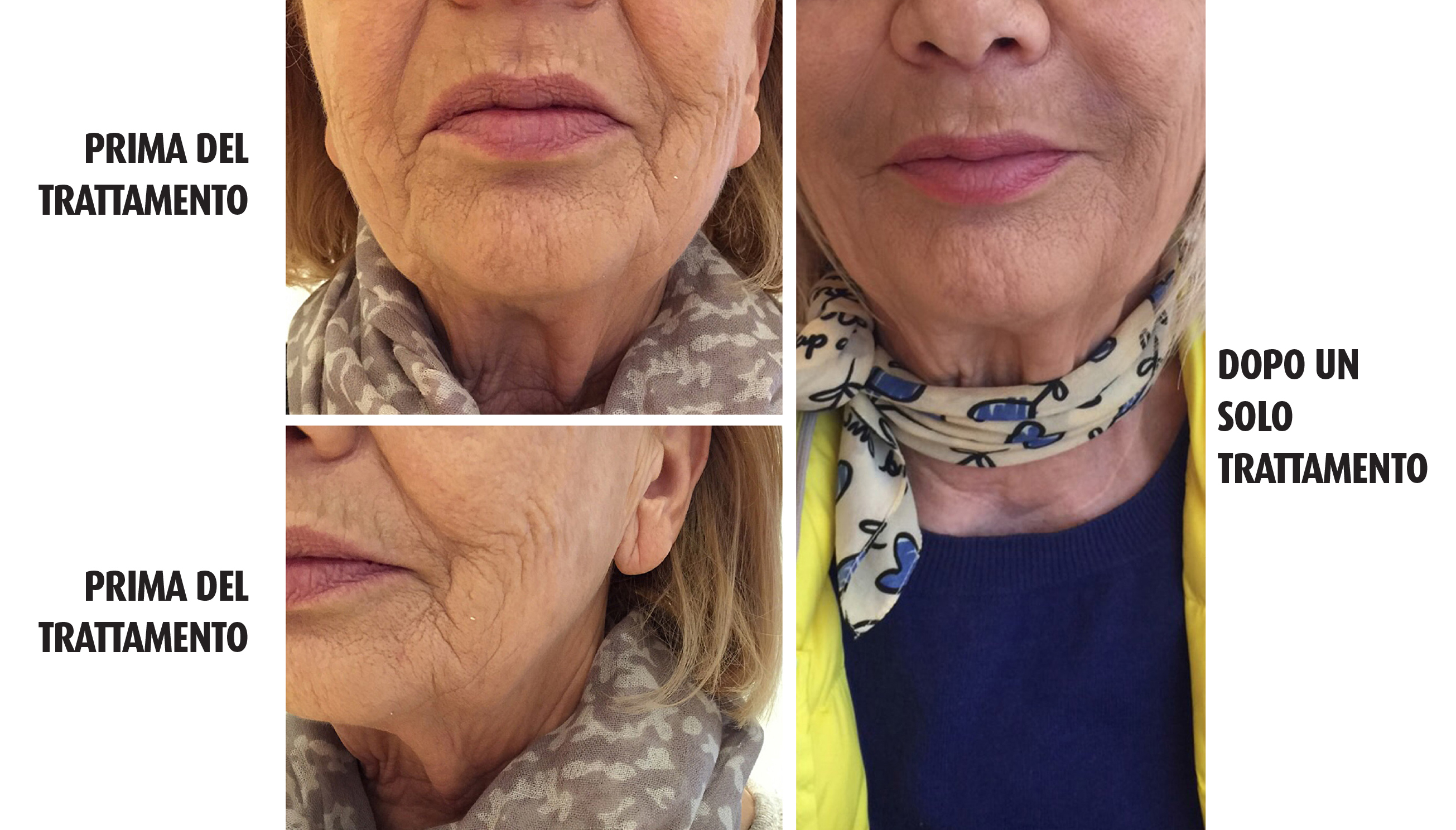 filler viso prezzi