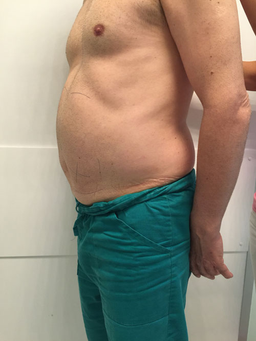 Deep Beauty Lipo Act