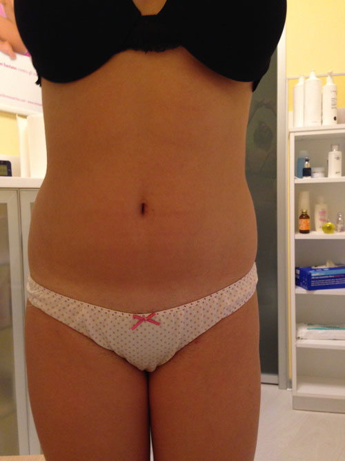 Deep Beauty Lipo Act